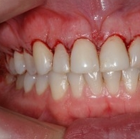bloedend tandvlees
