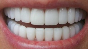 gebit van de mens wordt slechter