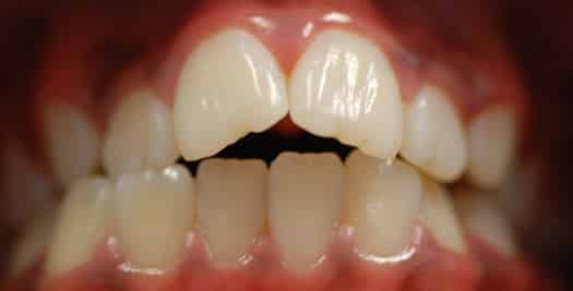 Brace - before overbite