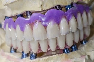 Klikgebit op implantaten