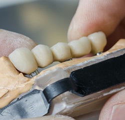 Brug op implantaten