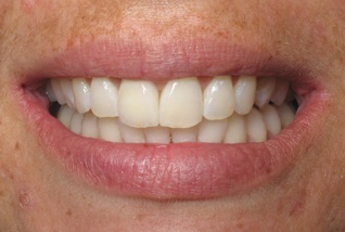 Kroon na - tand eruit