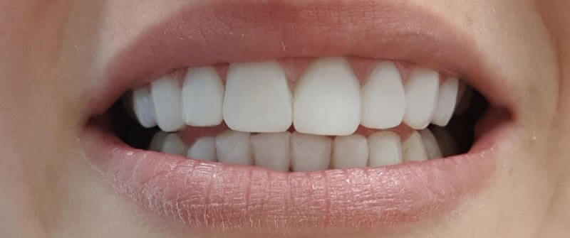 composite-veneers-after-min