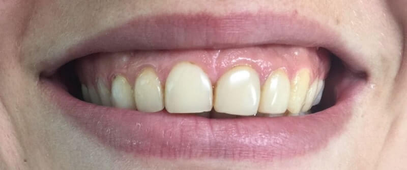 facings-composiet-voor-min