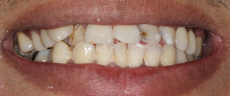 porselein-facings-voor-800-335