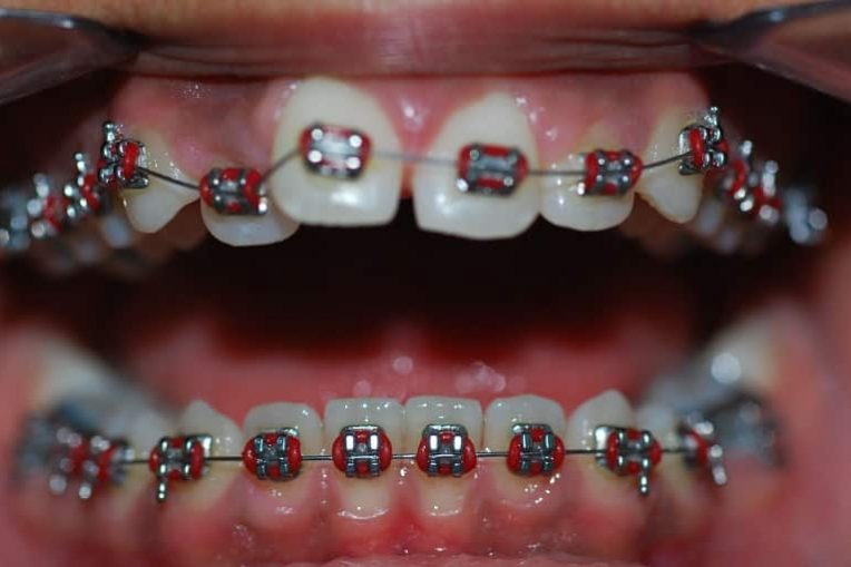 Beugelfoto-Nawal-3-tijdens-764x509