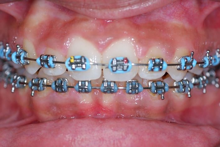 Beugelfoto-Nawal-4-tijdens-707x472